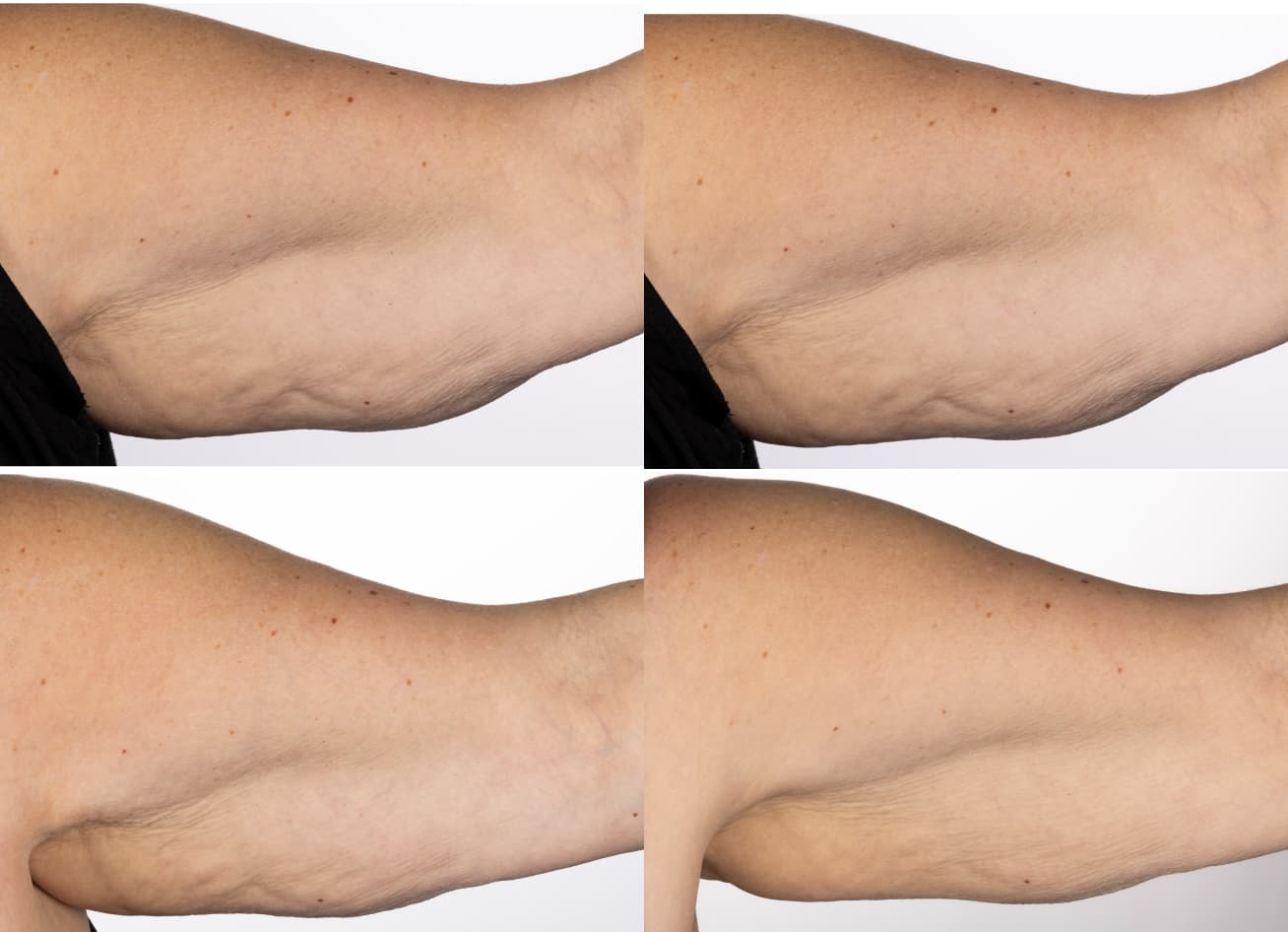RenuSpa iO before and after clinical study result